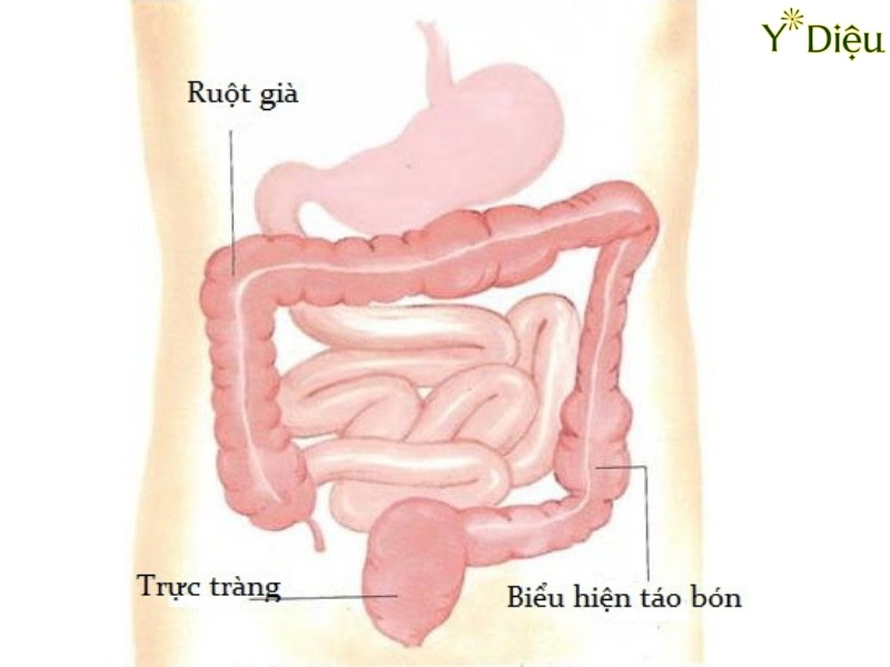 Táo Bón Sau Sinh Nguyên Nhân Và Cách Điều Trị Hiệu Quả